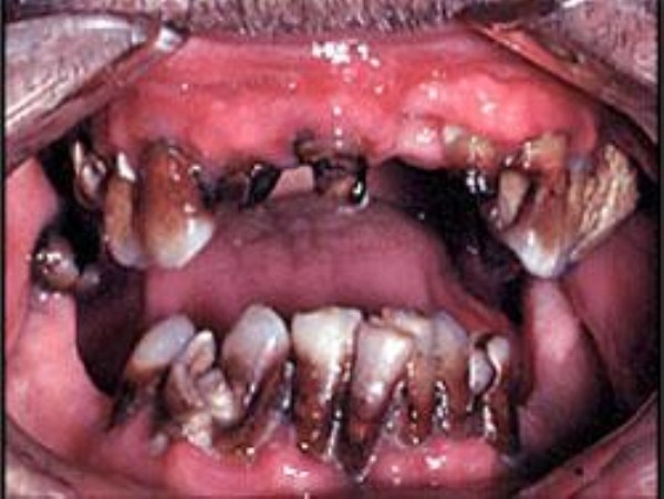 Meth Mouth (17 photos)