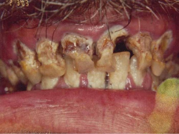 Meth Mouth (17 photos)