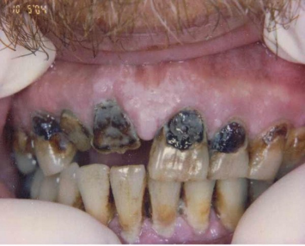 Meth Mouth (17 photos)