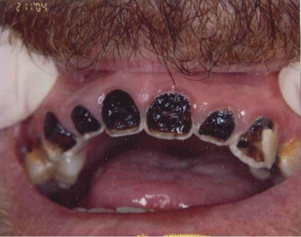 Meth Mouth (17 photos)