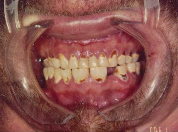 Meth Mouth (17 photos)