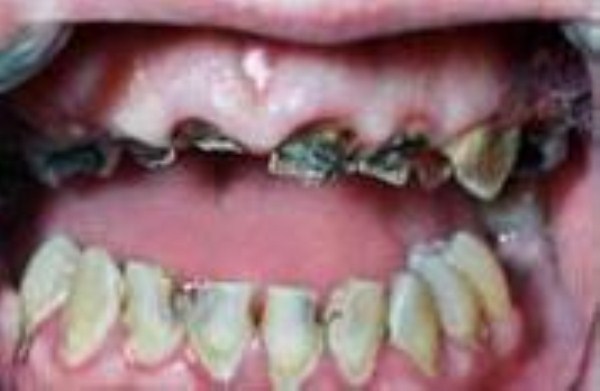 Meth Mouth (17 photos)