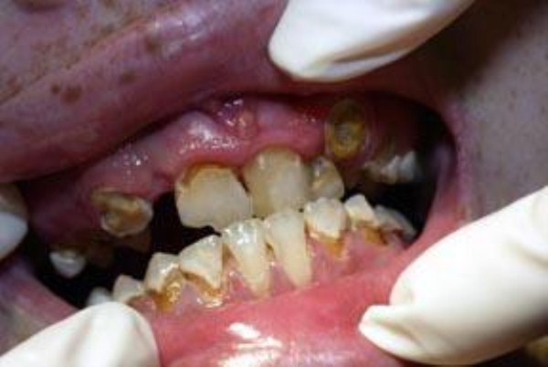 Meth Mouth (17 photos)