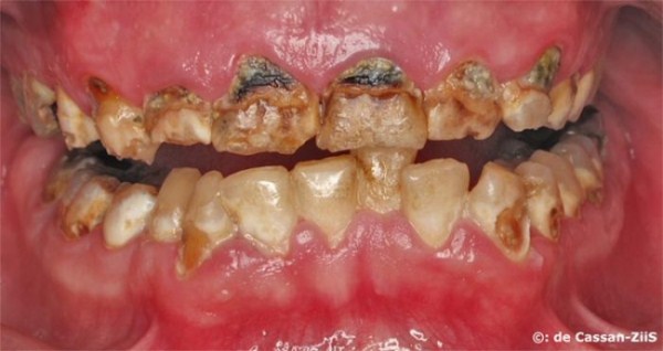 Meth Mouth (17 photos)