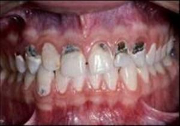 Meth Mouth (17 photos)