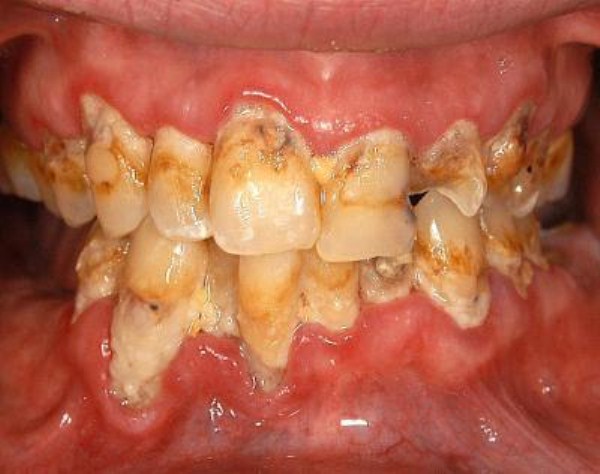 Meth Mouth (17 photos)