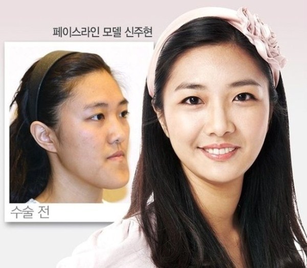 Plastic Surgery in South Korea (31 photos)