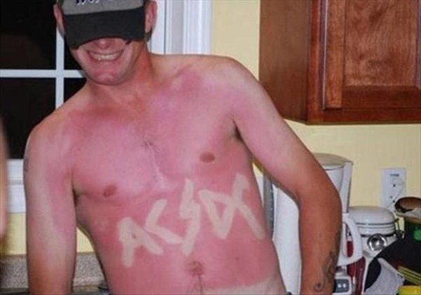 Painfully Funny Sunburns (20 photos)