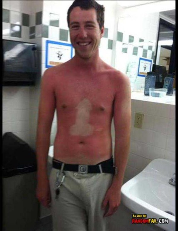 Painfully Funny Sunburns (20 photos)