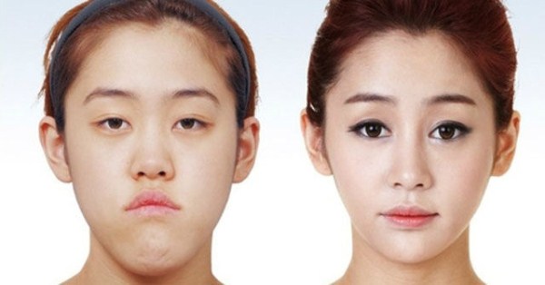 Young Koreans Before and After Plastic Surgery (62 photos)