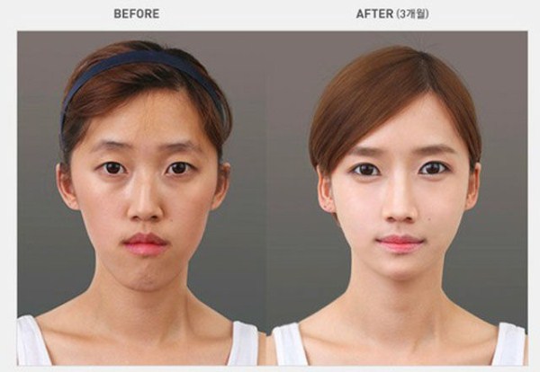 Young Koreans Before and After Plastic Surgery (62 photos)