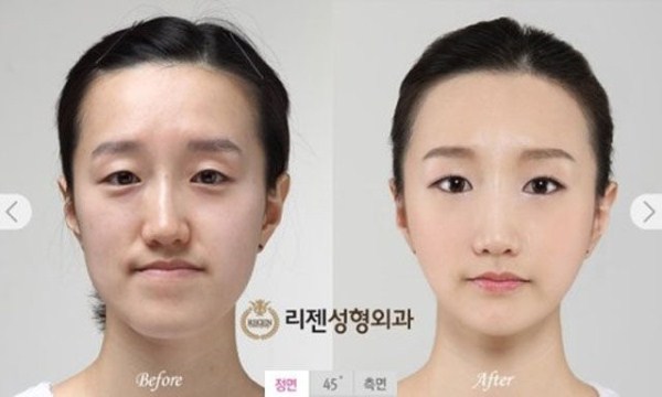 Young Koreans Before and After Plastic Surgery (62 photos)