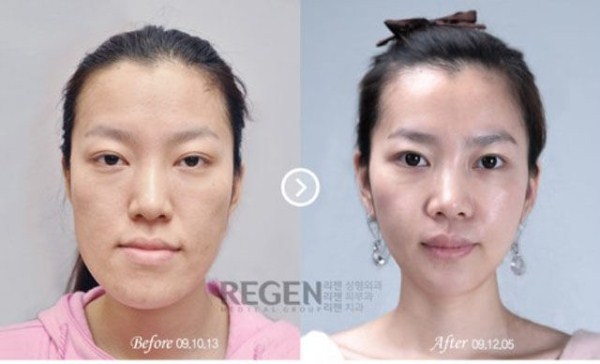 Young Koreans Before and After Plastic Surgery (62 photos)