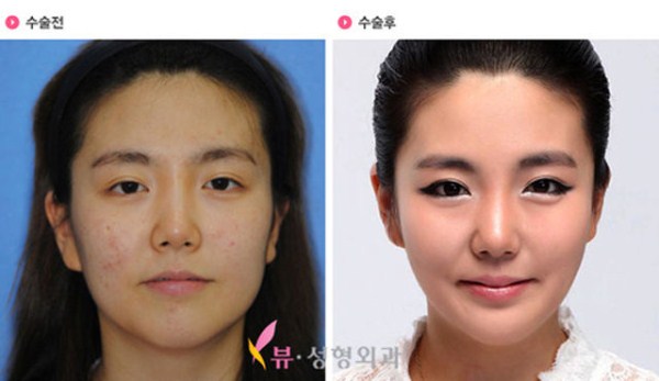 Young Koreans Before and After Plastic Surgery (62 photos)