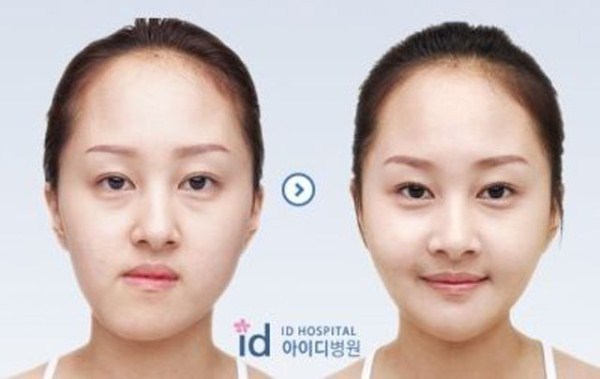 Young Koreans Before and After Plastic Surgery (62 photos)