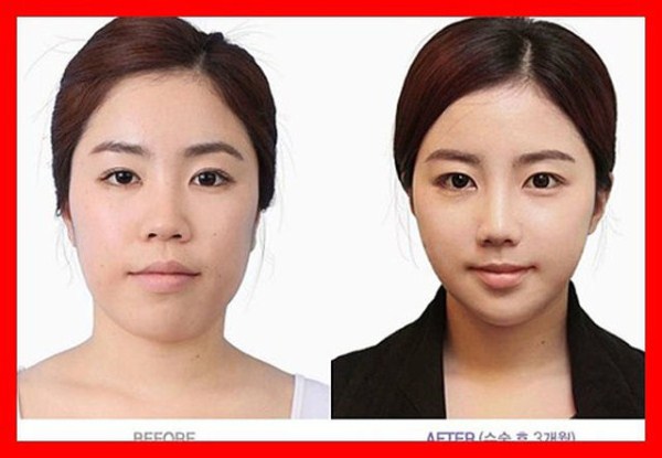Young Koreans Before and After Plastic Surgery (62 photos)