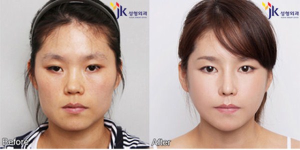 Young Koreans Before and After Plastic Surgery (62 photos)