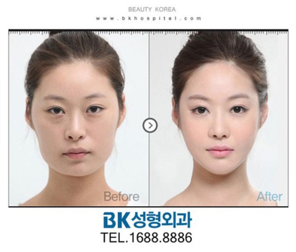 Young Koreans Before and After Plastic Surgery (62 photos)