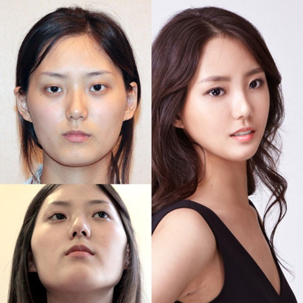 Young Koreans Before and After Plastic Surgery (62 photos)