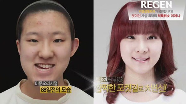Young Koreans Before and After Plastic Surgery (62 photos)