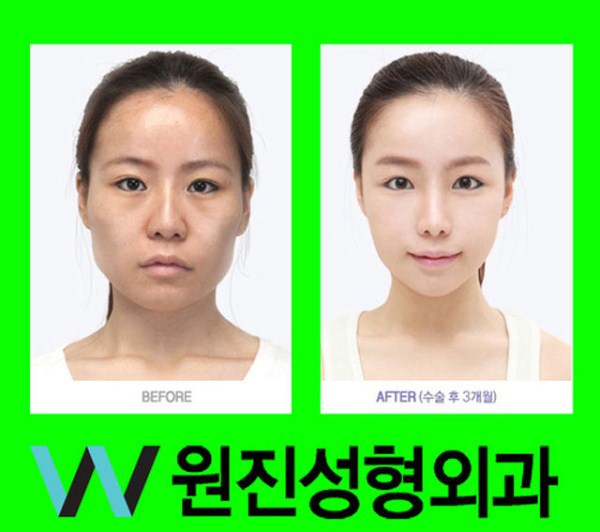 Young Koreans Before and After Plastic Surgery (62 photos)