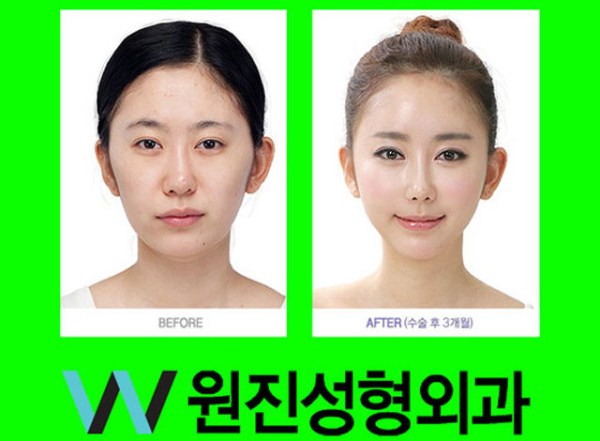 Young Koreans Before and After Plastic Surgery (62 photos)