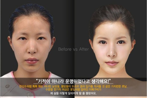 Young Koreans Before and After Plastic Surgery (62 photos)