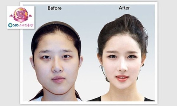 Young Koreans Before and After Plastic Surgery (62 photos)