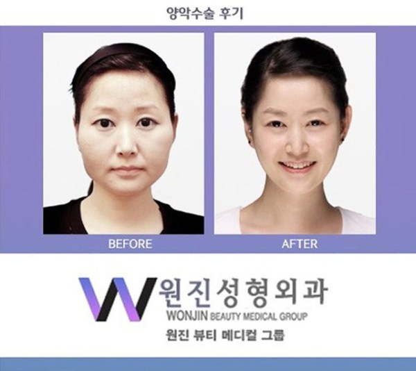 Young Koreans Before and After Plastic Surgery (62 photos)