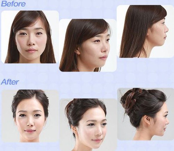 Young Koreans Before and After Plastic Surgery (62 photos)