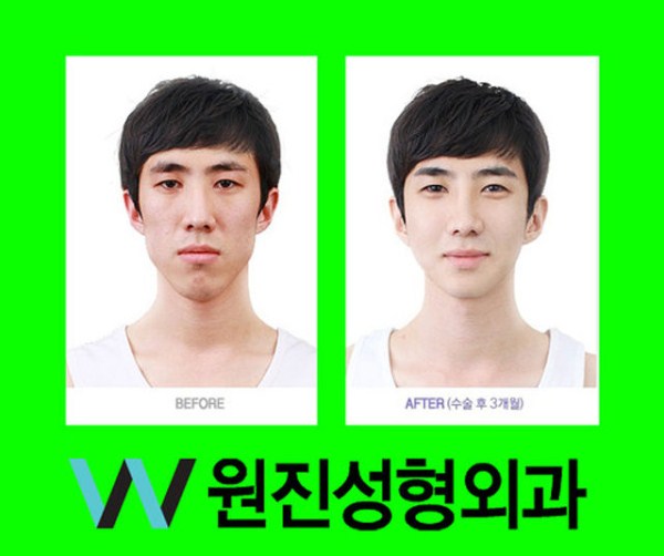 Young Koreans Before and After Plastic Surgery (62 photos)
