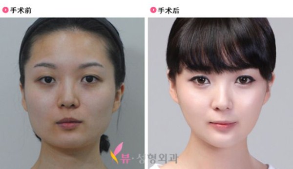 Young Koreans Before and After Plastic Surgery (62 photos)