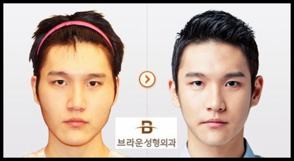 Young Koreans Before and After Plastic Surgery (62 photos)