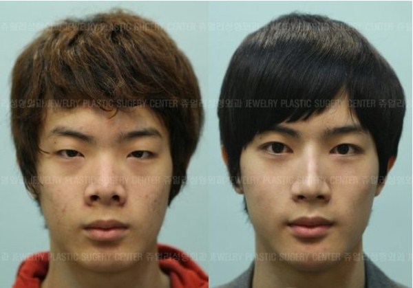 Young Koreans Before and After Plastic Surgery (62 photos)