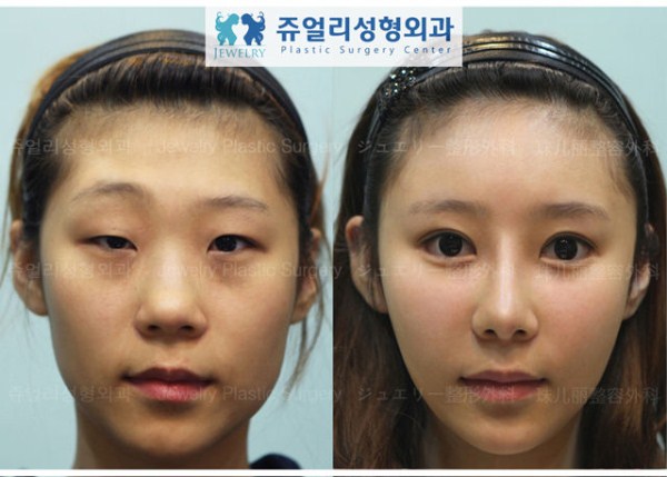 Young Koreans Before and After Plastic Surgery (62 photos)