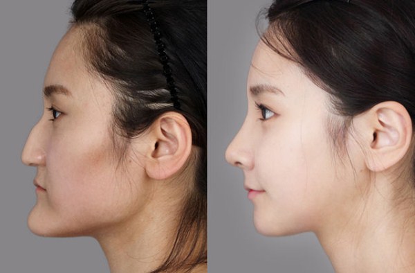 Young Koreans Before and After Plastic Surgery (62 photos)