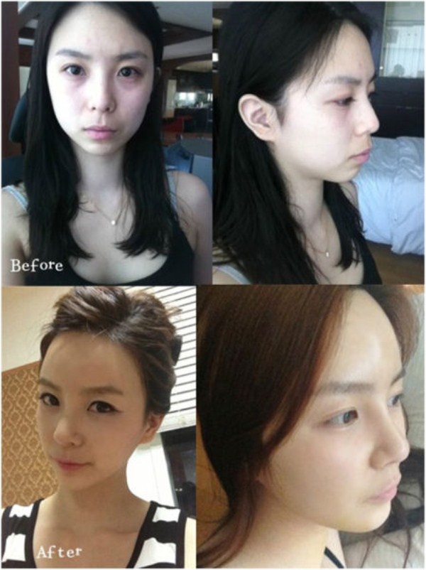 Young Koreans Before and After Plastic Surgery (62 photos)