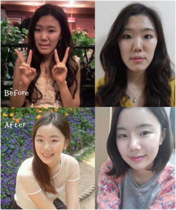 Young Koreans Before and After Plastic Surgery (62 photos)