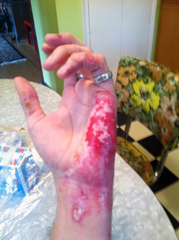 The Healing Process of a Burnt Hand (13 photos)