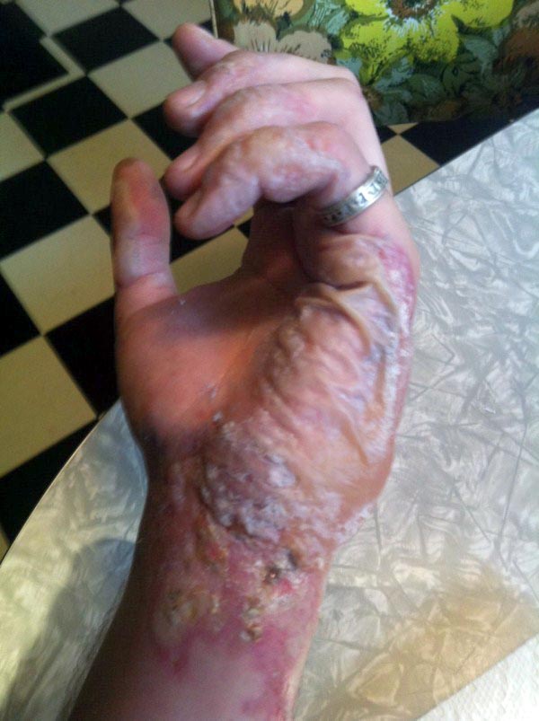 The Healing Process of a Burnt Hand (13 photos)