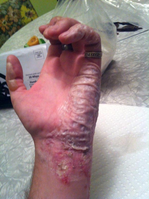 The Healing Process of a Burnt Hand (13 photos)