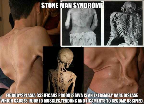Extremely Rare and Bizarre Medical Disorders (12 photos)