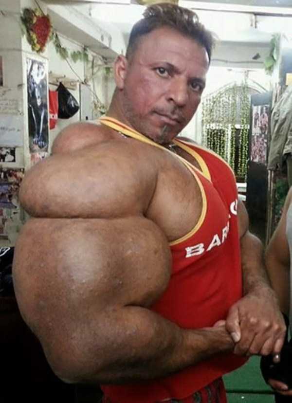 Terrible Overuse of Synthol (20 photos)