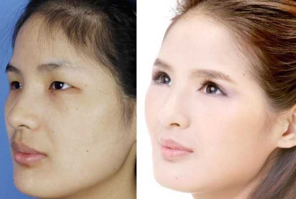 Chinese Women Before and After Plastic Surgery Procedures (19 photos)