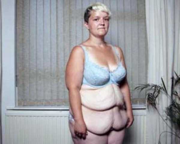 People With Excess Skin (28 photos)