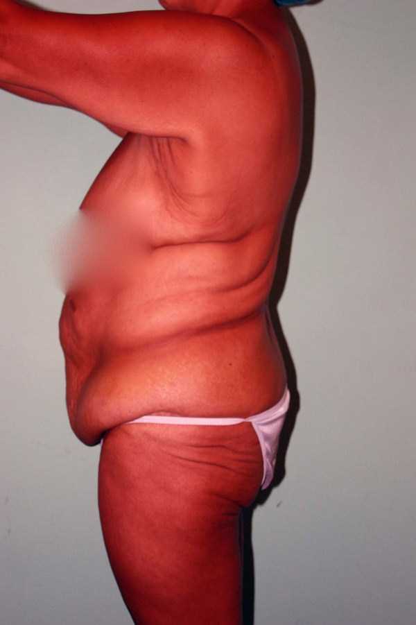 weight loss excess skin 3