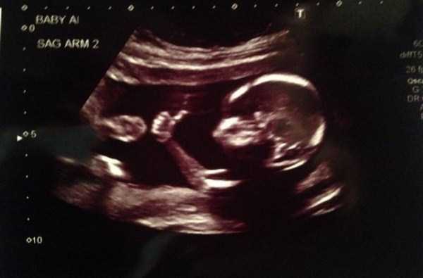 funny ultrasound photos 1