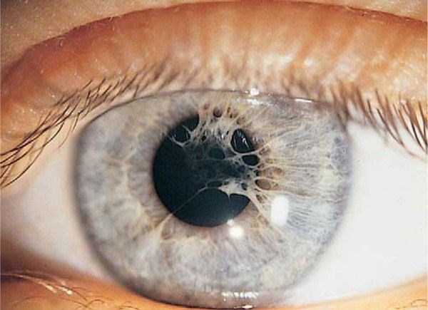 Seriously Messed Up Human Eyes (24 photos)