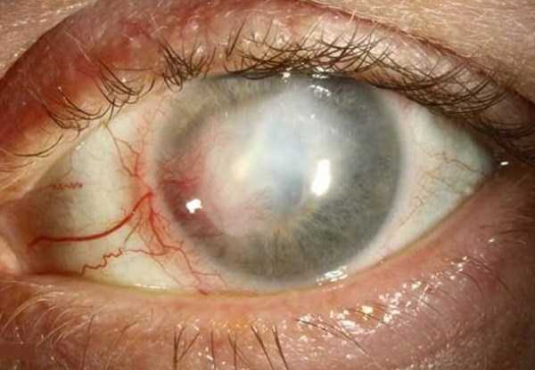 Seriously Messed Up Human Eyes (24 photos)