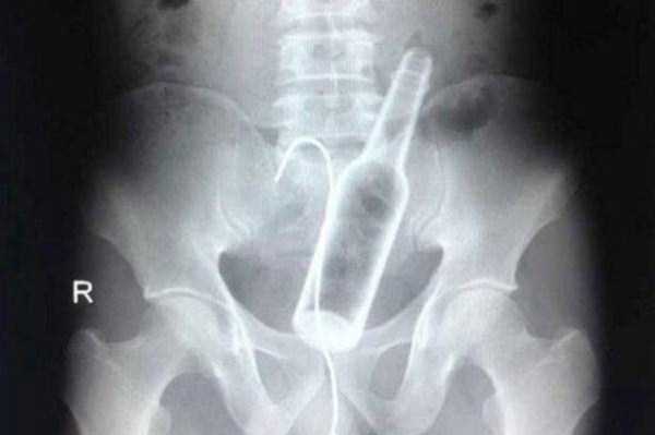 Bizarre Objects Found in Peoples Butts (27 photos)